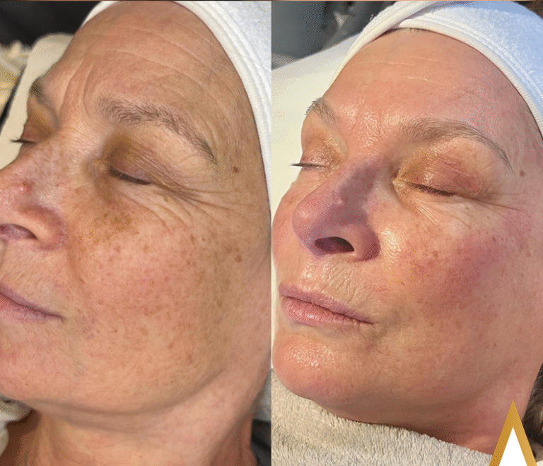 Microdermabrasion – SkinBase Facial